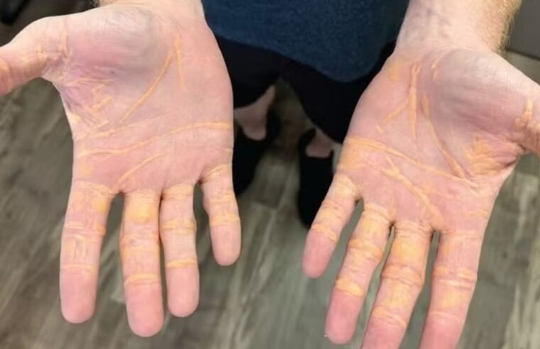 Xantelasma: entenda o quadro que cria nódulos de gordura no corpo por excesso de colesterol
