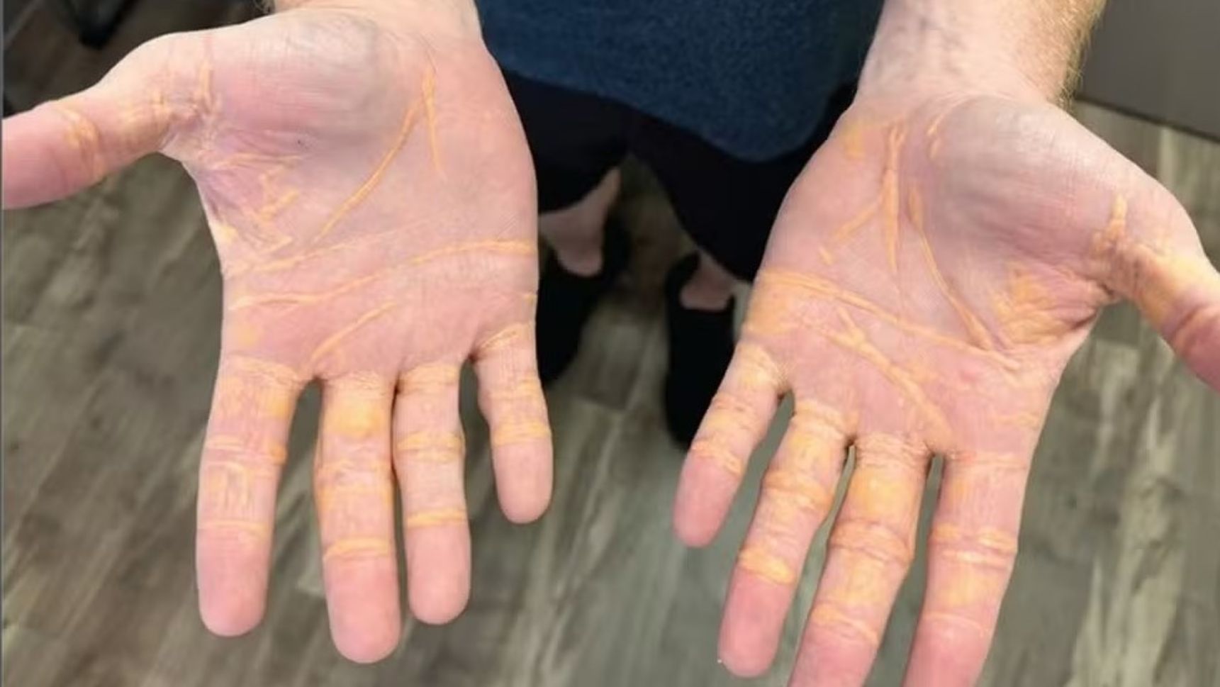 Xantelasma: entenda o quadro que cria nódulos de gordura no corpo por excesso de colesterol